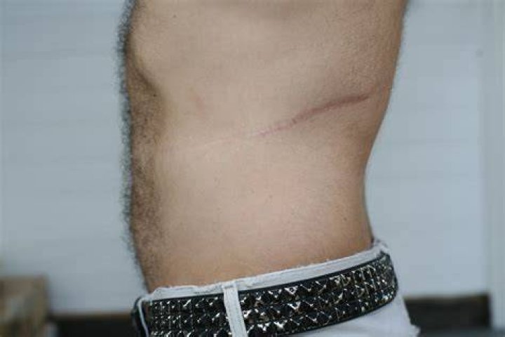 Scar You can save someone's life. You need only one kidney&hellip; Flickr